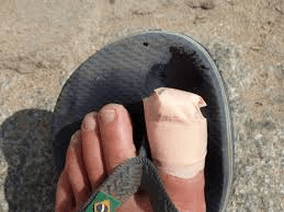 toe injury