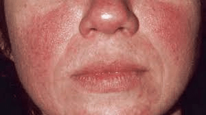 rosacea